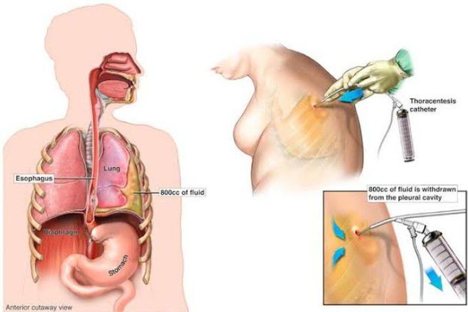 Treatment for pleural effusion