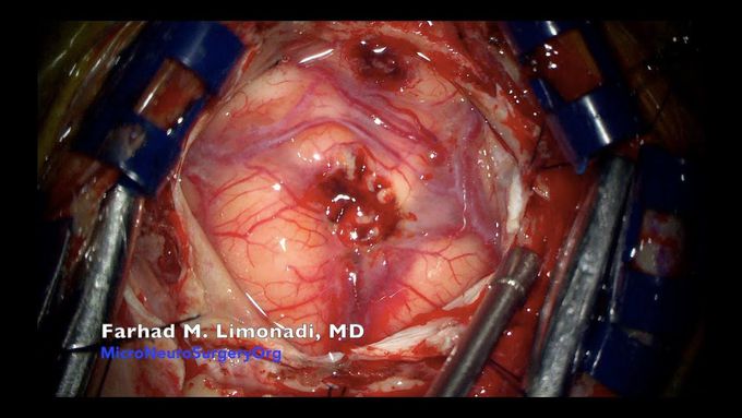 Brain operation: Surgical removal of brain tumor, glioblastoma multiforme (GBM)