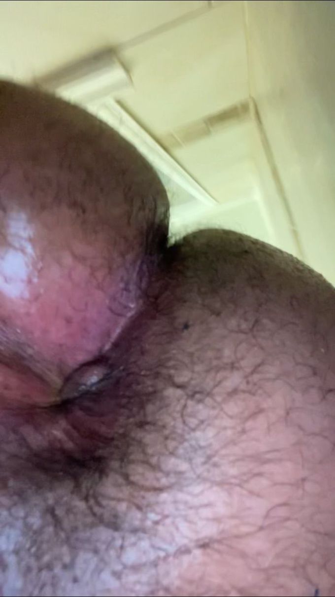 Bump on anus