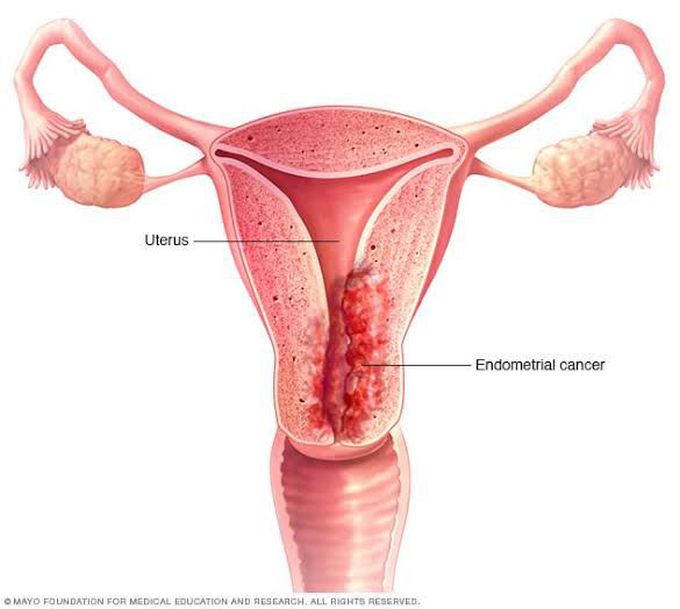 How to prevent endometrial carcinoma?