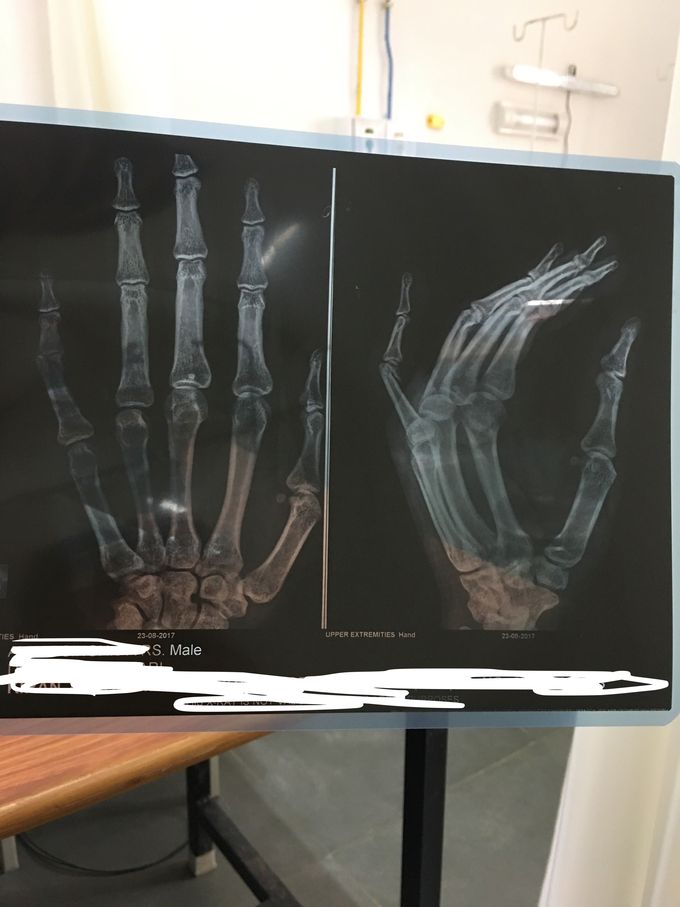 31 yo male with fracture of distal proximal phalanges