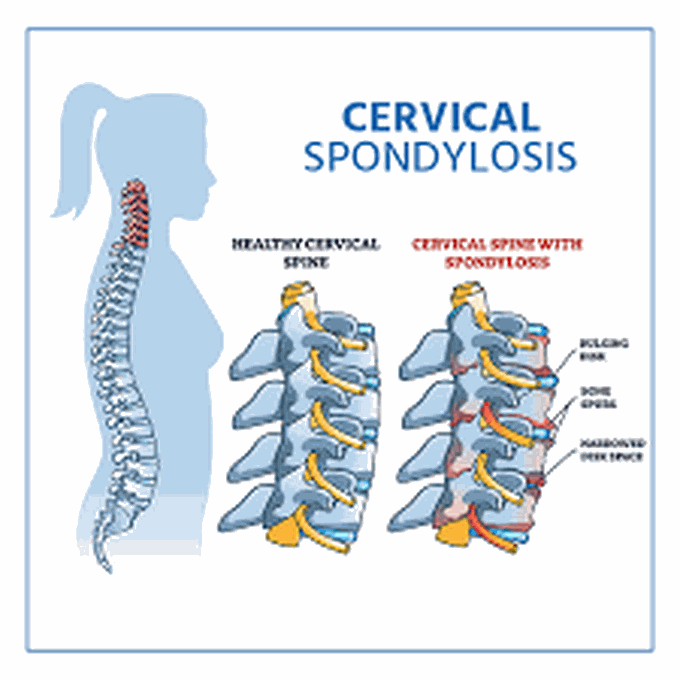 Causes of spondylosis