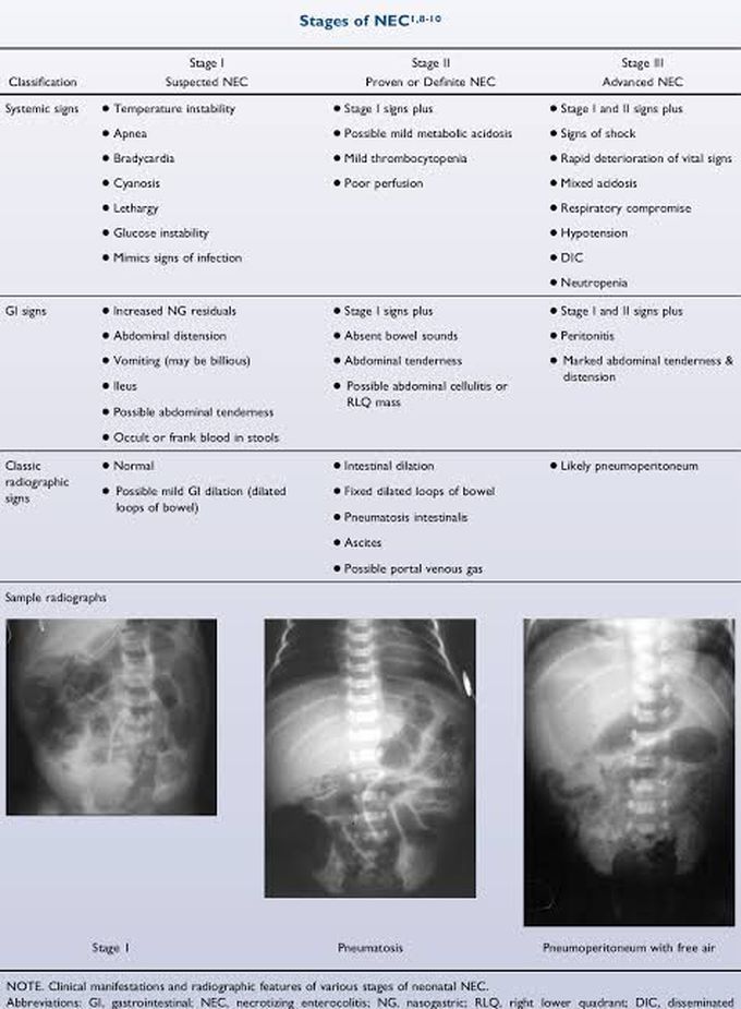 Stages of necrotizing enterocolitis