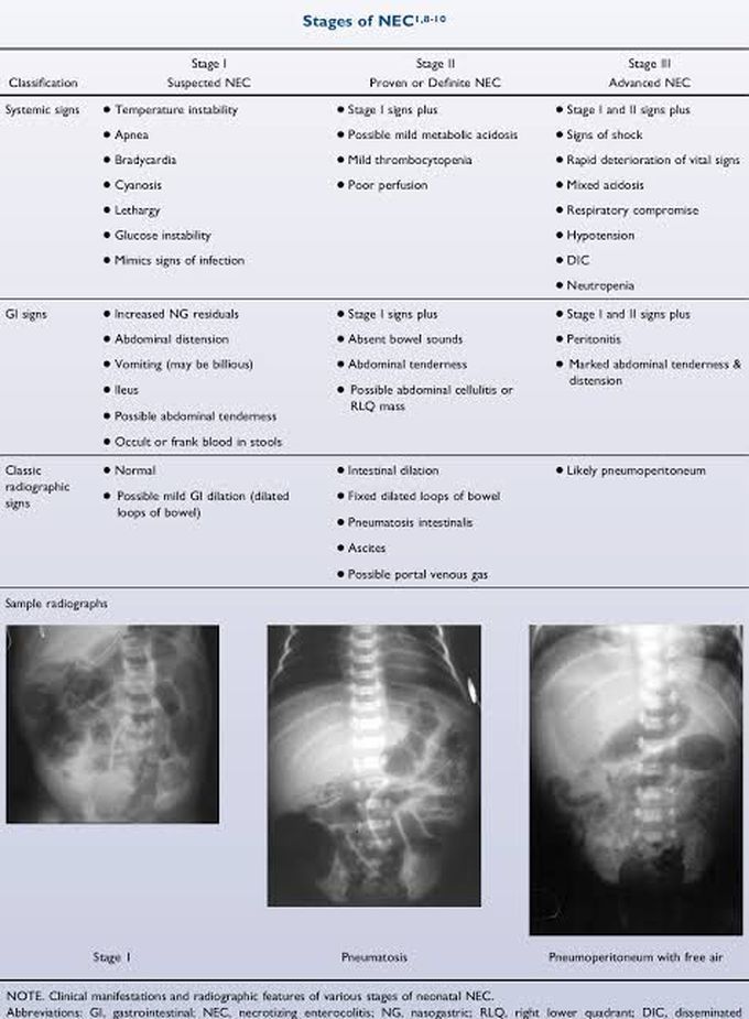 Stages of necrotizing enterocolitis