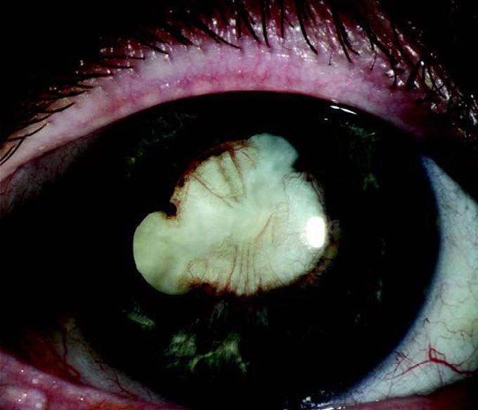 48-year-old woman presented with asymmetric vision loss. Which of the following is NOT a possible cause for this appearance?