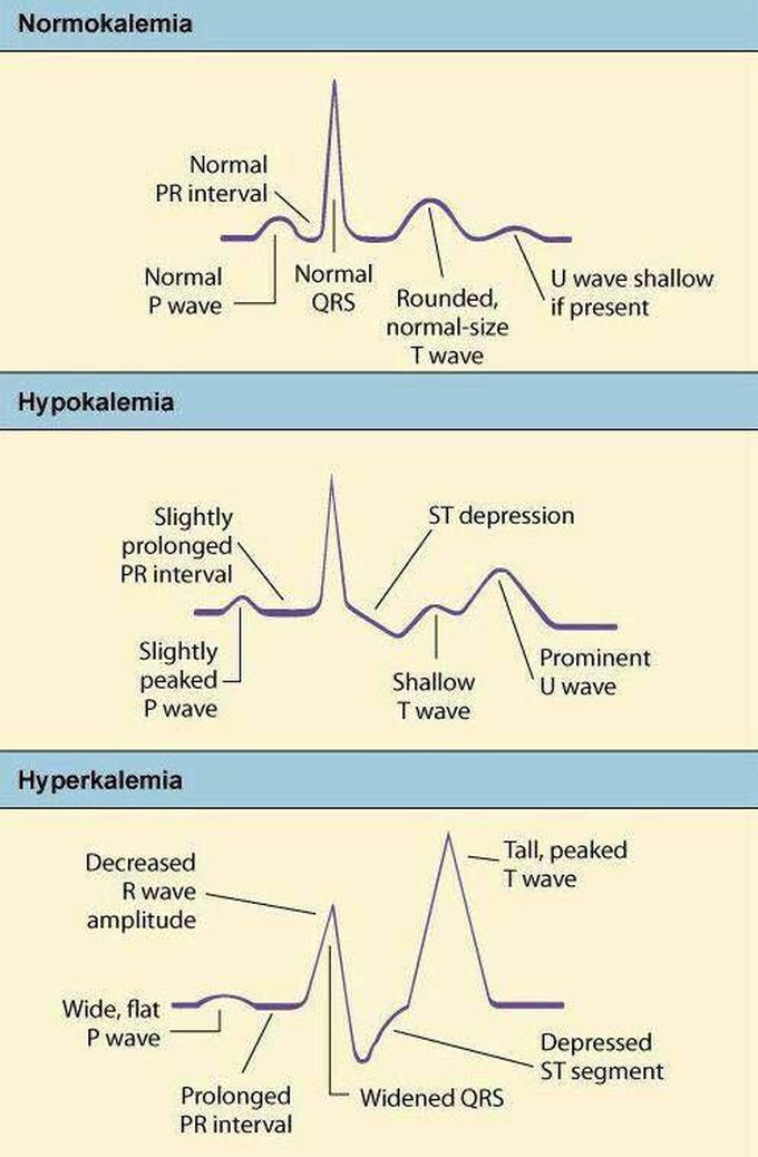 ECG