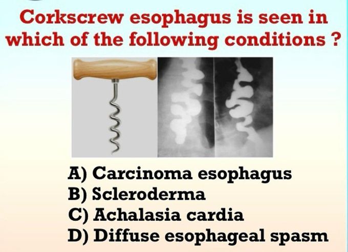 Corkscrew Esophagus