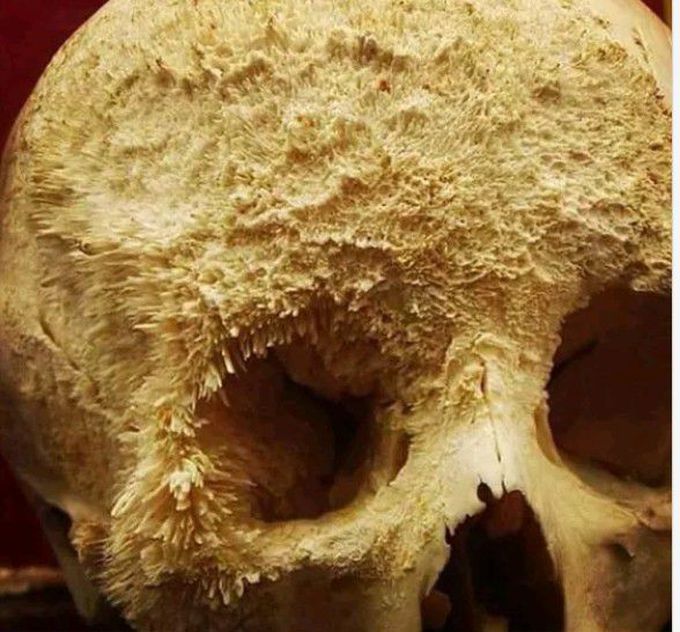Bone cancer