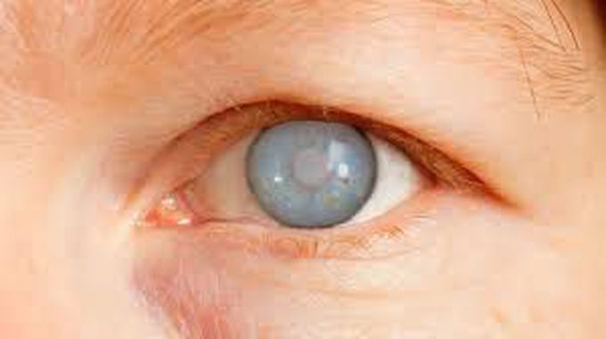 Risk factors of glaucoma