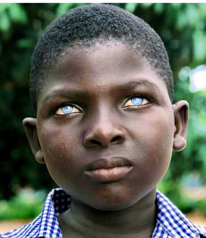 Ocular albinism