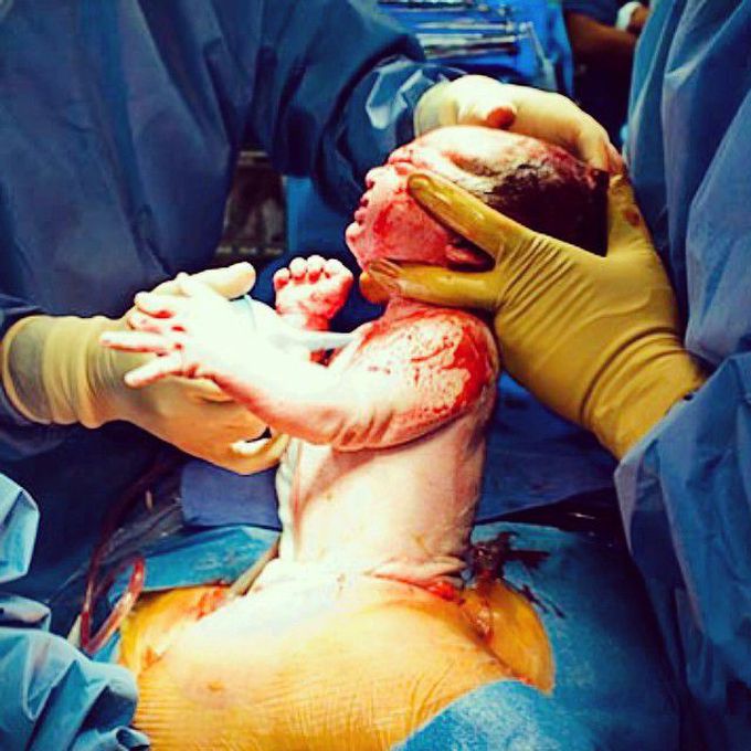 Baby born by C-section (caesarean delivery)