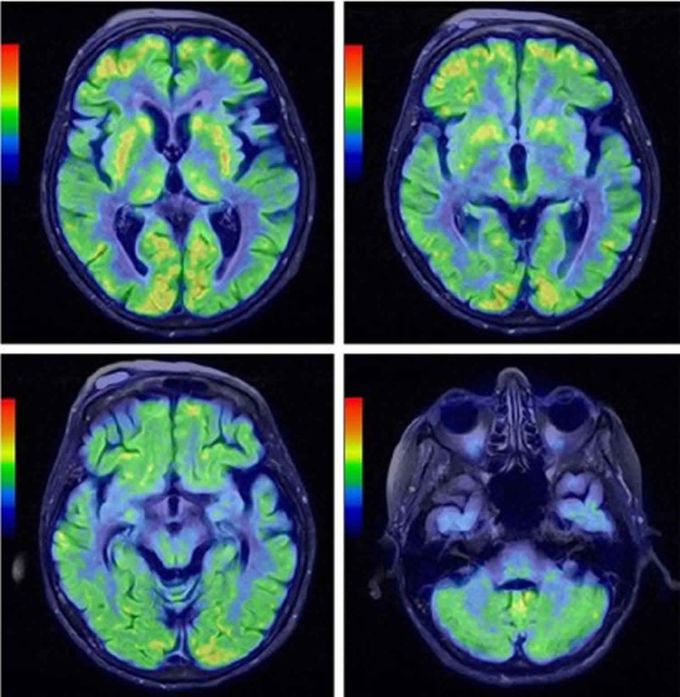 Shy-Drager Syndrome