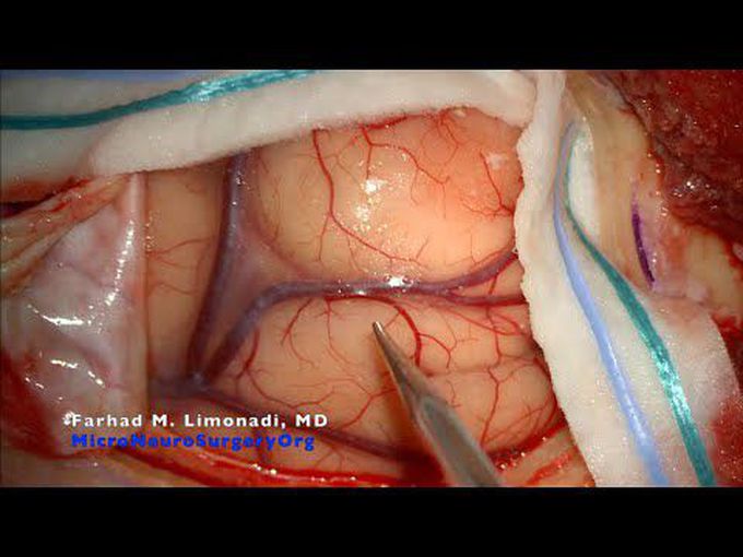Brain Tumor Resection: Frontal craniotomy and resection of tumor using minimal invasive principles.