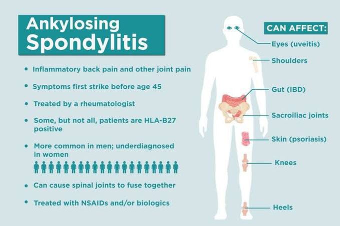 Ankylosing spondylitis