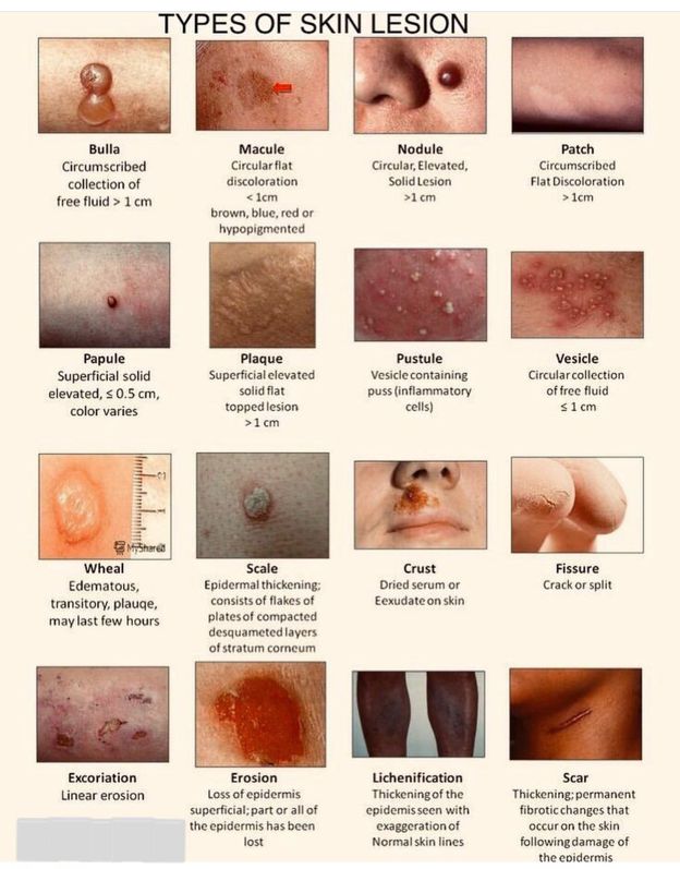 Types of skin lesson - MEDizzy