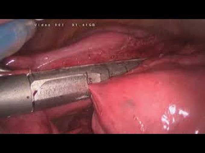 Re-VATS Left Upper Lobectomy With Pulmonary Artery Plasty After Induction Chemotherapy