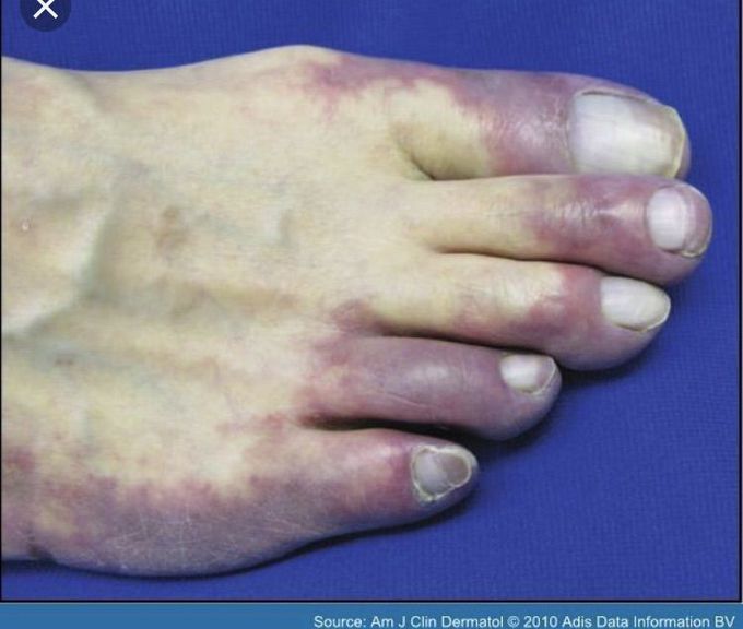 Blue toe syndrome is one of the frequent manifestations of tissue ischaemia. It is caused by the occlusion of small vessels, and usually occurs in elderly men who undergo an invasive vascular procedure.