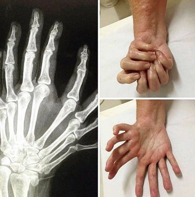 Polydactylism