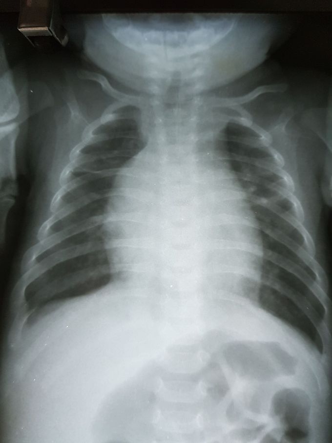 Cardiomegalia