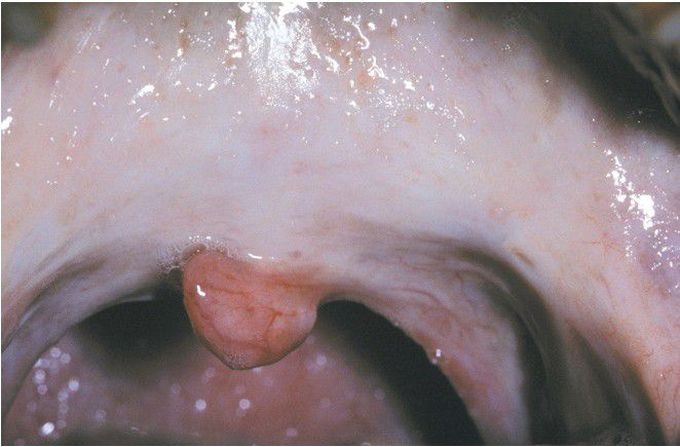 Oral Submucous Fibrosis