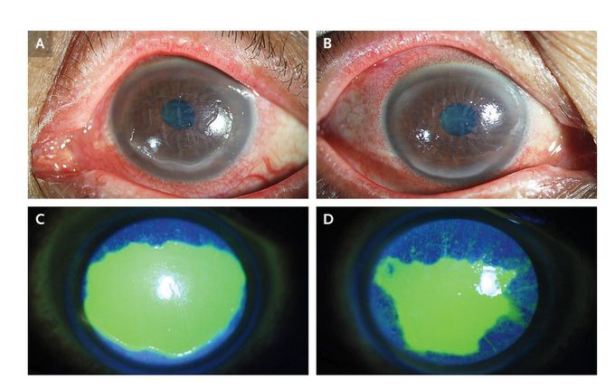 Keratoconjunctivitis Sicca in Sjögren’s Syndrome