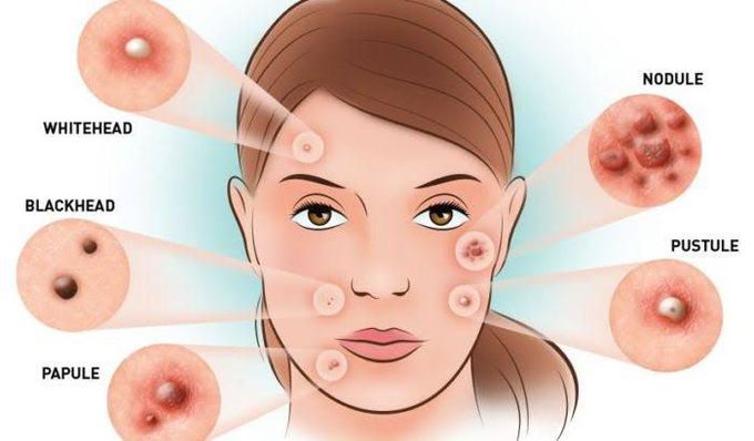 ACNE - Skin condition