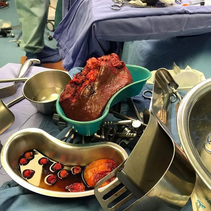 RIGHT HEMIHEPATECTOMY