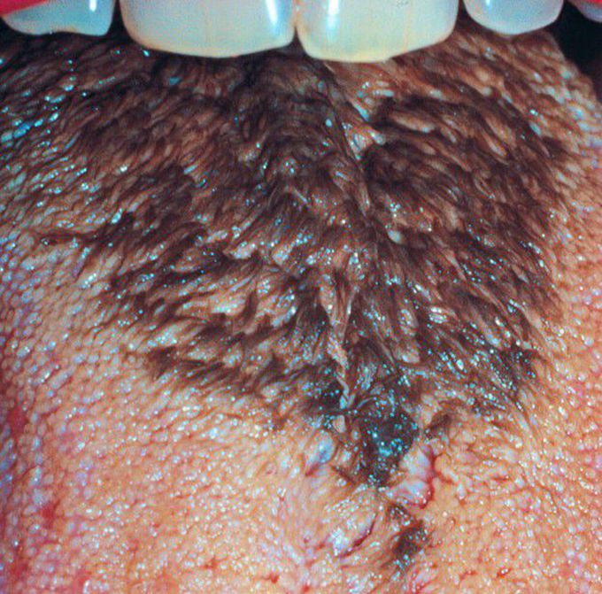 Black hairy tongue