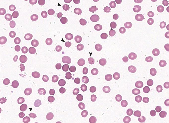 Spur-Cell Hemolytic Anemia