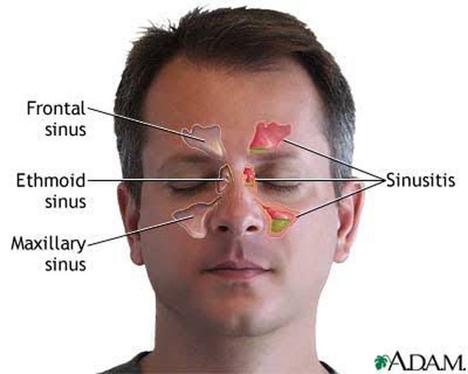 Symptoms of sinusitis