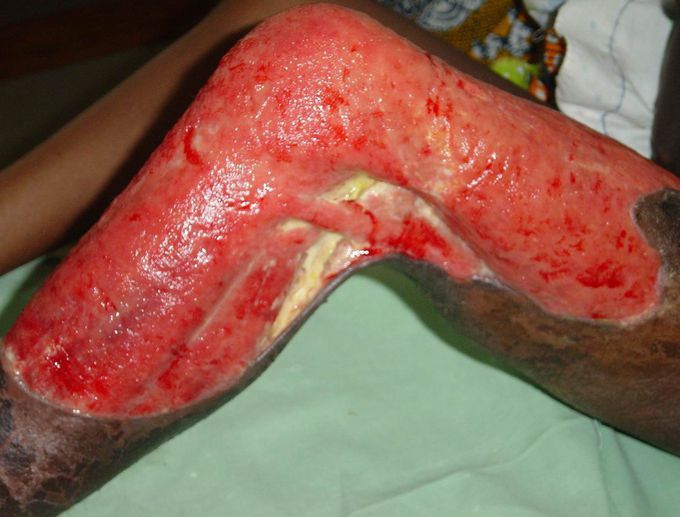 File:Scars of yaws lesions on the legs of a female patient with a