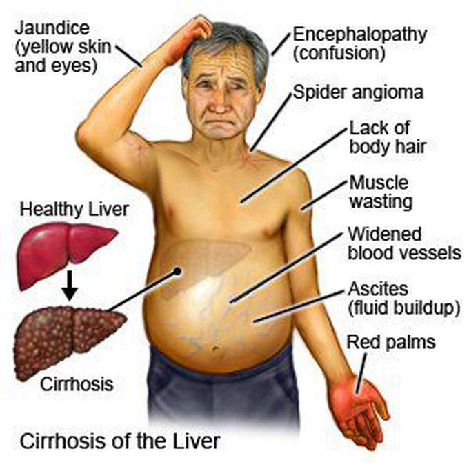 Symptoms of Cirrhosis of liver