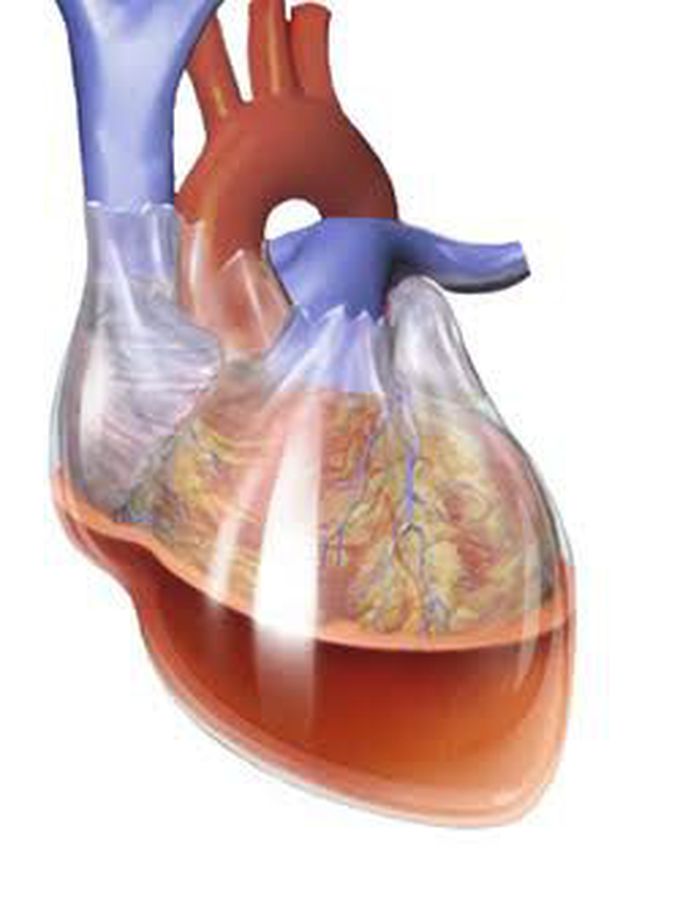 Causes of cardiac temponade