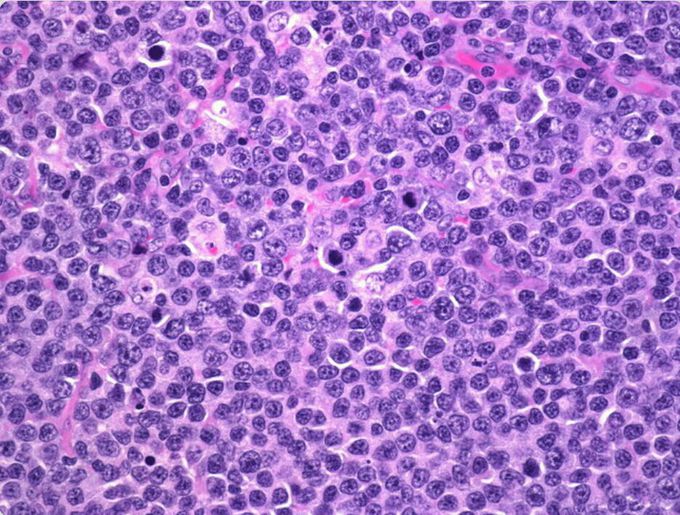 BURKITT LYMPHOMA-HISTOLOGY