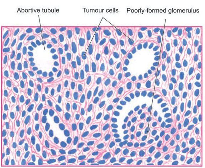 Wilms’ tumour.