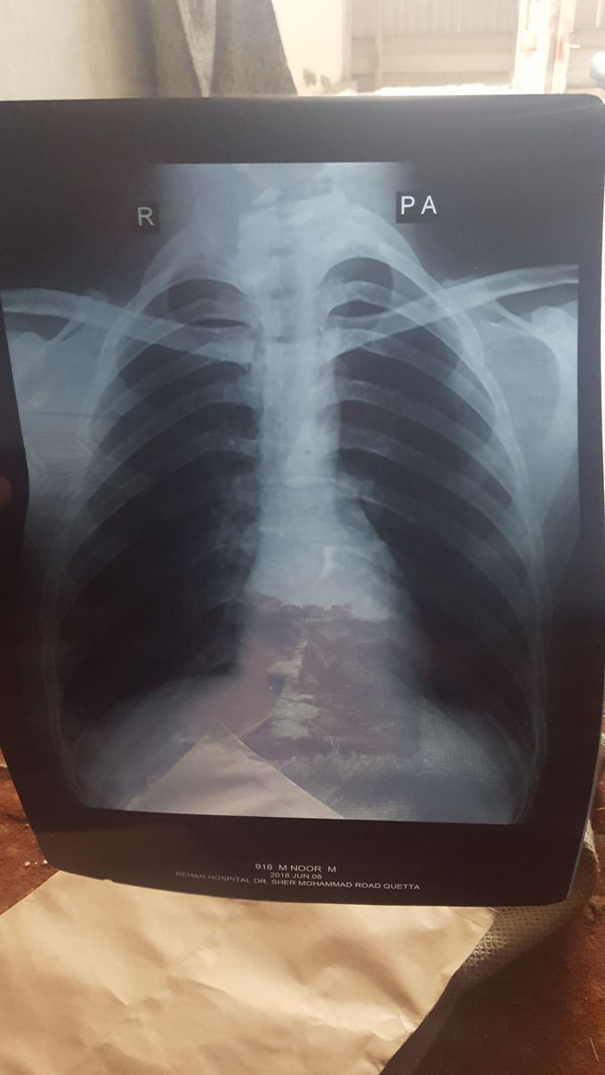 Short breathing age 18 above