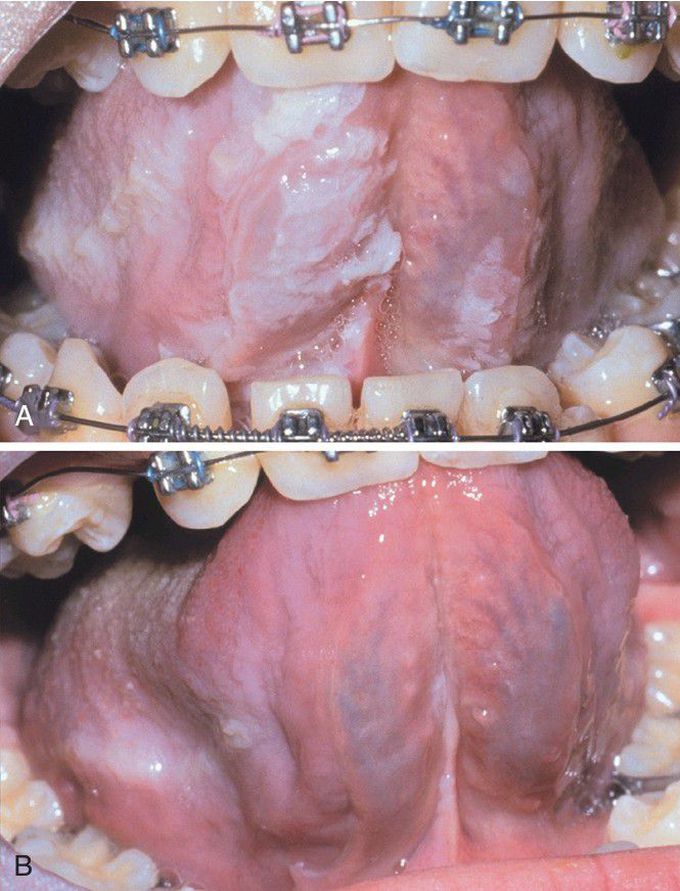 Uremic Stomatitis.