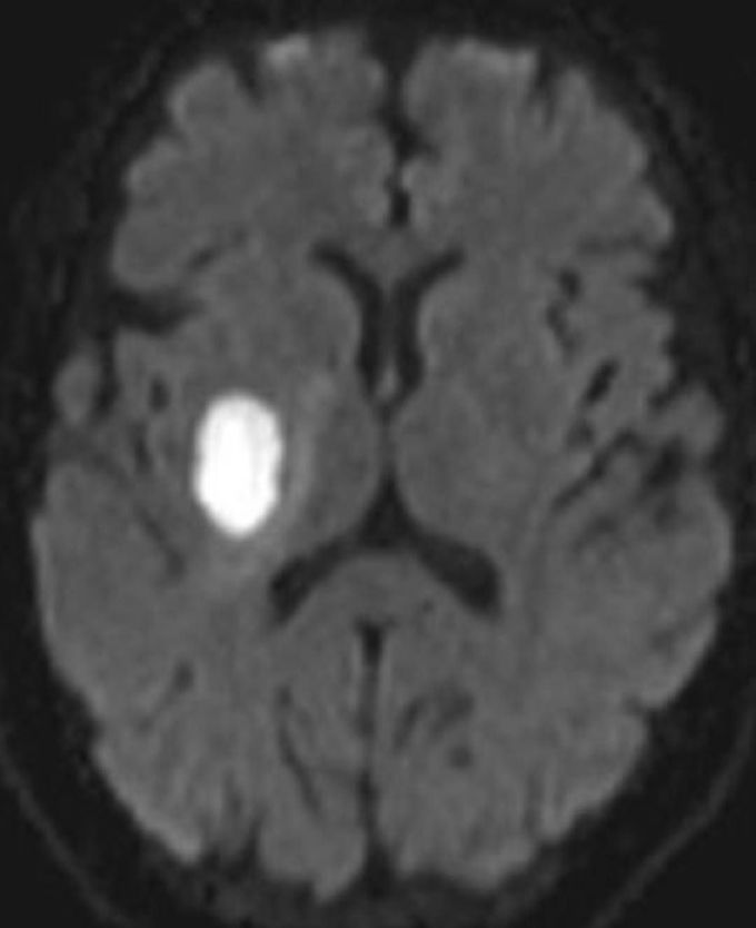 Cerebral abscess