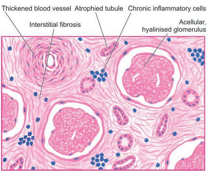 End-stage kidney in chronic GN, light microscopy.