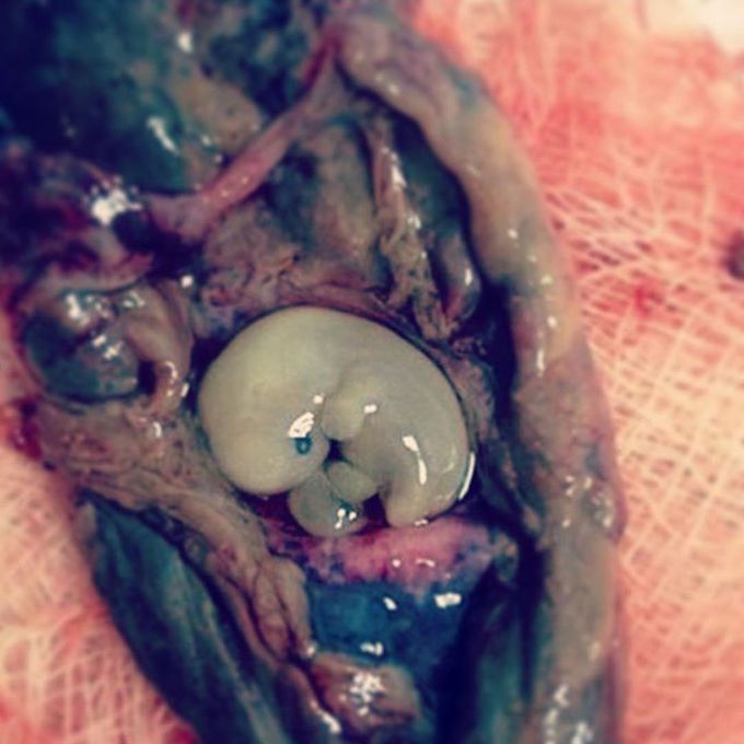 A very unique shot of a case of miscarriage