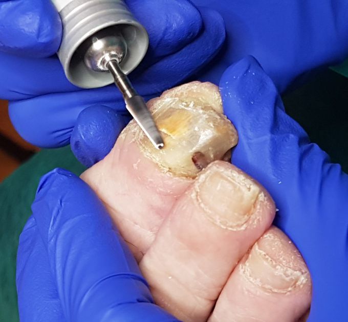 Onychomycosis