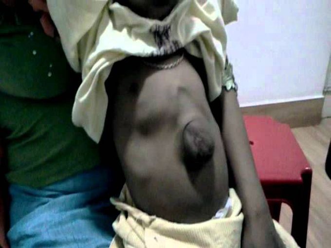 Ectopia Cordis - A rare congenital abnormality with the heart