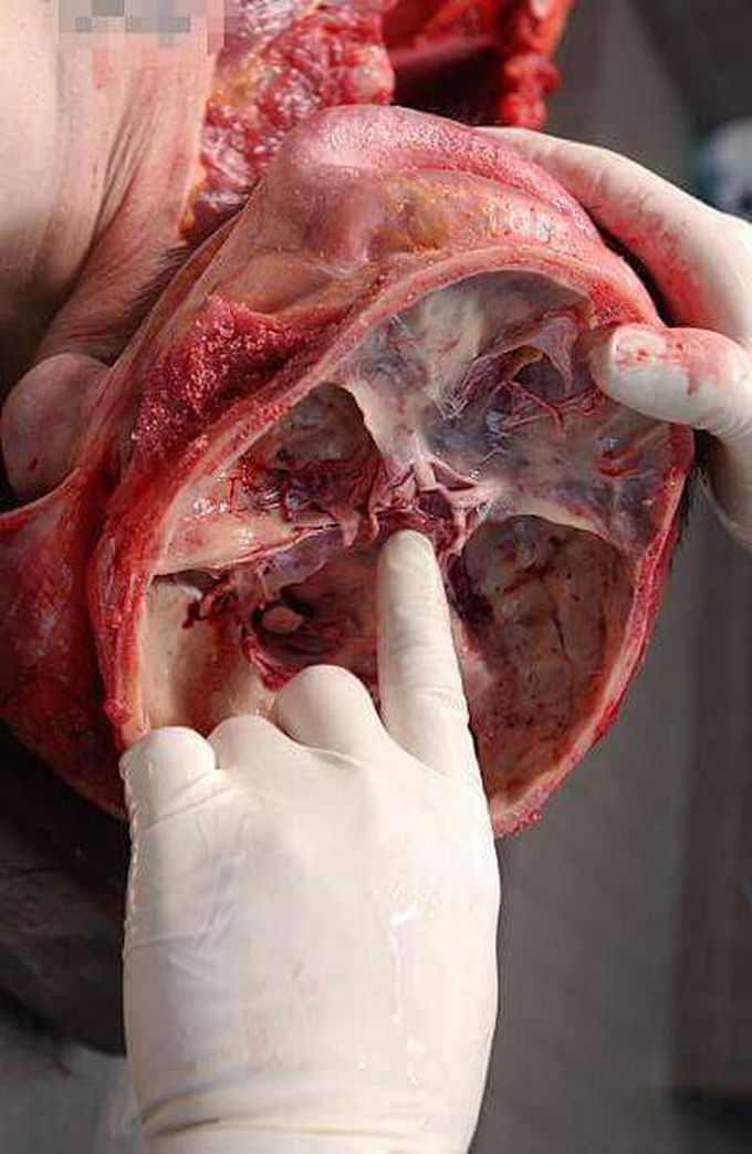 Human Skull - Autopsy