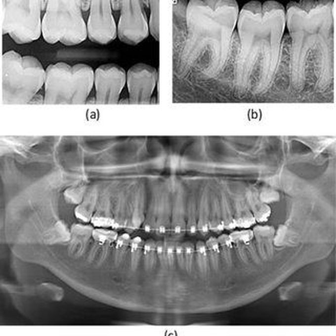 Bitewing radiograph uses