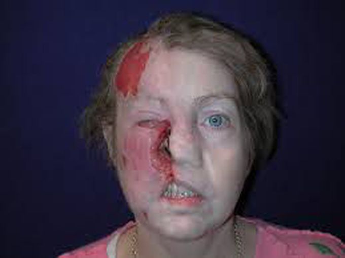 Trigeminal Trophic Syndrome