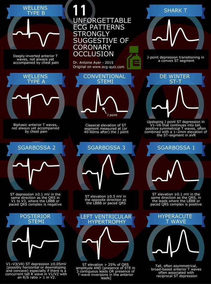 Some important ECG patterns