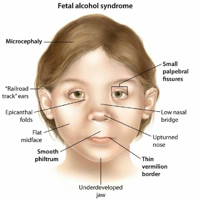 Fetal Alcoholic Syndrome