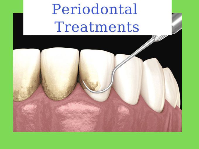 Treatment for Periodontitis