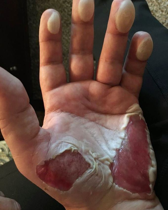 Case of a severely burned hand after alpine slide gone wrong! 