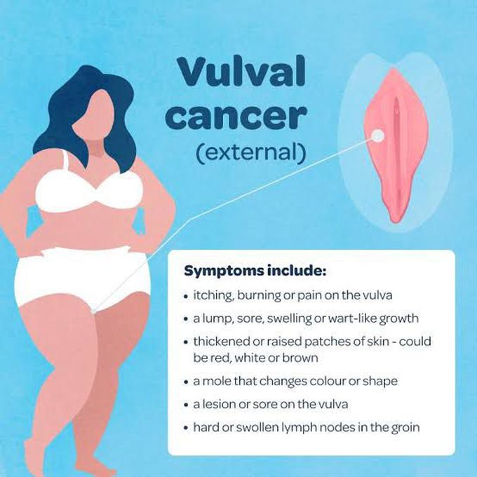 Symptoms of vulvul cancer